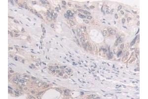 Detection of FKBP4 in Human Colorectal cancer Tissue using Polyclonal Antibody to FK506 Binding Protein 4 (FKBP4)