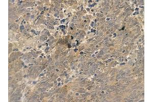 ABIN6262671 and ABIN6273002 at 1/100 staining human small cell lung carcinoma by IHC-P. (ISCU anticorps  (Internal Region))
