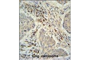 C19orf50 Antibody (Center) (ABIN653085 and ABIN2842681) immunohistochemistry analysis in formalin fixed and paraffin embedded human lung carcinoma followed by peroxidase conjugation of the secondary antibody and DAB staining. (C19orf50 anticorps  (AA 59-85))