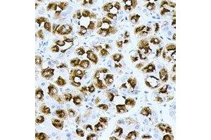 Immunohistochemical analysis of H-Ras staining in human gastric cancer formalin fixed paraffin embedded tissue section. (HRAS anticorps)