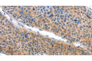 Immunohistochemistry of paraffin-embedded Human liver cancer tissue using ARL11 Polyclonal Antibody at dilution 1:50 (ARL11 anticorps)