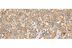 Immunohistochemistry of paraffin-embedded Human liver cancer tissue using CHKA Polyclonal Antibody at dilution of 1:35(x200) (Choline Kinase alpha anticorps)