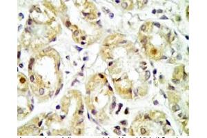 Human stomach cancer tissue was stained by rabbit Anti-Spexin prepro (36-58)  Antibody (Spexin anticorps  (Preproprotein))