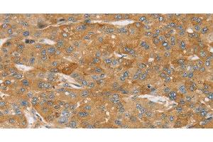 Immunohistochemistry of paraffin-embedded Human liver cancer using TPD54 Polyclonal Antibody at dilution of 1:35 (TPD52L2 anticorps)