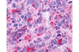 Anti-GPR39 antibody IHC of human Brain, Glioblastoma.