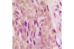 Immunohistochemical analysis of SMAD4 staining in human breast cancer formalin fixed paraffin embedded tissue section.