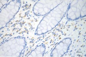 Immunohistochemistry was performed on paraffin-embedded human sigmoid colon carcinoma using p53 antibody (ABIN7800686), 1:200). (Recombinant p53 anticorps)