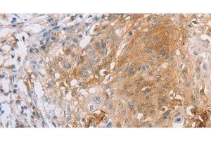 Immunohistochemistry of paraffin-embedded Human cervical cancer tissue using CD85d Polyclonal Antibody at dilution 1:30 (LILRB2 anticorps)