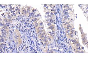 Detection of Bcl2 in Human Endometrial cancer Tissue using Monoclonal Antibody to B-Cell Leukemia/Lymphoma 2 (Bcl2)