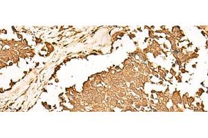 Immunohistochemistry of paraffin-embedded Human lung cancer tissue using PWP1 Polyclonal Antibody at dilution of 1:70(x200) (PWP1 anticorps)