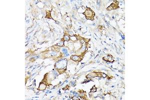 Immunohistochemistry of paraffin-embedded human lung cancer using MMP7 Rabbit pAb (ABIN3021102, ABIN3021103, ABIN3021104, ABIN1513214 and ABIN6213952) at dilution of 1:150 (40x lens). (MMP7 anticorps  (AA 18-267))