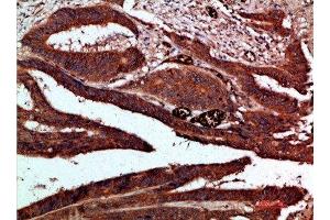 Immunohistochemical analysis of paraffin-embedded human-colon-cancer, antibody was diluted at 1:200 (CDK6 anticorps  (AA 280-325))