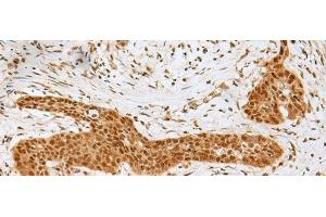 Immunohistochemistry of paraffin-embedded Human esophagus cancer tissue using GOLGA7 Polyclonal Antibody at dilution of 1:40(x200) (Golgin A7 anticorps)