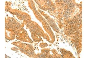 The image on the left is immunohistochemistry of paraffin-embedded Human colon cancer tissue using ABIN7131139(SOCS6 Antibody) at dilution 1/35, on the right is treated with fusion protein. (SOCS6 anticorps)