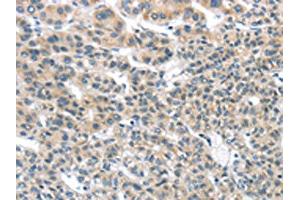 The image on the left is immunohistochemistry of paraffin-embedded Human liver cancer tissue using ABIN7131349(THSD1 Antibody) at dilution 1/25, on the right is treated with fusion protein.