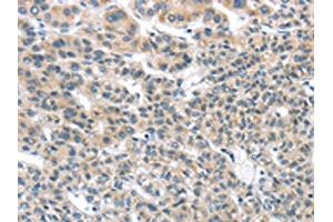 The image on the left is immunohistochemistry of paraffin-embedded Human liver cancer tissue using ABIN7131349(THSD1 Antibody) at dilution 1/25, on the right is treated with fusion protein. (THSD1 anticorps)