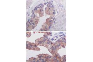 Immunohistochemical analysis of paraffin-embedded human normal prostate tissue (A) and prostate adenocarcinoma tissue (B), showing cytoplasmic localization using AMACR monoclonal antibody, clone 2A10F3  with DAB staining.