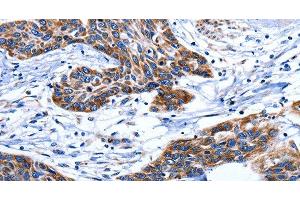 Immunohistochemistry of paraffin-embedded Human esophagus cancer tissue using AQP8 Polyclonal Antibody at dilution 1:75 (Aquaporin 8 anticorps)