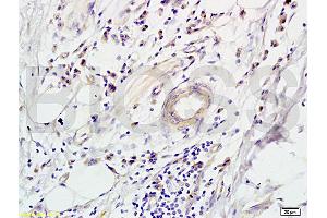 Formalin-fixed and paraffin-embedded human colon carcinoma labeled with Rabbit Anti-CD118 Polyclonal Antibody (ABIN686827), Unconjugated 1:200 followed by conjugation to the secondary antibody and DAB staining (LIFR anticorps  (AA 451-580))