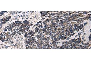 Immunohistochemistry of paraffin-embedded Human colorectal cancer tissue using CCNI Polyclonal Antibody at dilution of 1:65(x200) (Cyclin I anticorps)