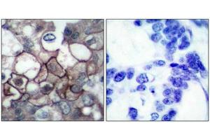 Immunohistochemical analysis of paraffin-embedded human breast carcinoma tissue using EGFR(Phospho-Tyr1197) Antibody(left) or the same antibody preincubated with blocking peptide(right). (EGFR anticorps  (pTyr1197))