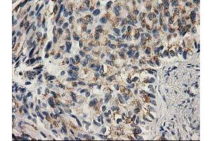 Immunohistochemical staining of paraffin-embedded Carcinoma of Human lung tissue using anti-PNMT mouse monoclonal antibody. (PNMT anticorps)