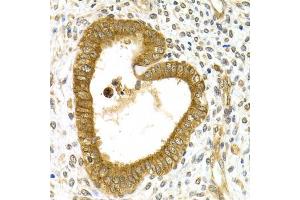 Immunohistochemistry of paraffin-embedded human adenomyosis using RAB27A Antibody (ABIN5970998) at dilution of 1/200 (40x lens). (RAB27A anticorps)