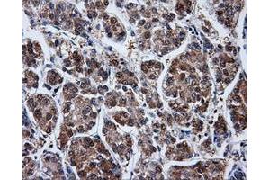Immunohistochemical staining of paraffin-embedded Carcinoma of liver tissue using anti-PPME1mouse monoclonal antibody. (PPME1 anticorps)