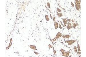 This antibody stained formalin-fixed, paraffin-embedded sections of human breast invasive ductal carcinoma. (WNT3A anticorps)