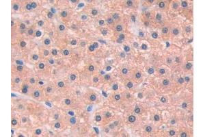 IHC-P analysis of Human Liver cancer Tissue, with DAB staining. (IL13 Receptor alpha 1 anticorps  (AA 203-376))
