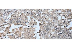 Immunohistochemistry of paraffin-embedded Human lung cancer tissue using UBR2 Polyclonal Antibody at dilution of 1:55(x200) (UBR2 anticorps)