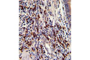 Formalin-fixed and paraffin-embedded human colon carcinoma with CNOT8 Antibody (C-term), which was peroxidase-conjugated to the secondary antibody, followed by DAB staining. (CNOT8 anticorps  (C-Term))