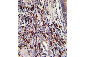 Formalin-fixed and paraffin-embedded human colon carcinoma with CNOT8 Antibody (C-term), which was peroxidase-conjugated to the secondary antibody, followed by DAB staining. (CNOT8 anticorps  (C-Term))