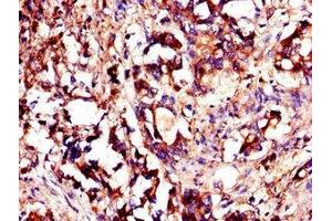 Immunohistochemistry of paraffin-embedded human gastric cancer using ABIN7174080 at dilution of 1:100 (YES1 anticorps  (AA 1-155))