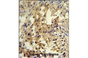U antibody (C-term) (ABIN654948 and ABIN2844589) immunohistochemistry analysis in formalin fixed and paraffin embedded human kidney carcinoma followed by peroxidase conjugation of the secondary antibody and DAB staining. (UPP2 anticorps  (C-Term))