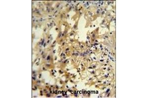 U antibody (C-term) (ABIN654948 and ABIN2844589) immunohistochemistry analysis in formalin fixed and paraffin embedded human kidney carcinoma followed by peroxidase conjugation of the secondary antibody and DAB staining. (UPP2 anticorps  (C-Term))