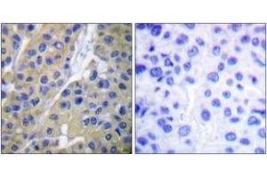Immunohistochemistry analysis of paraffin-embedded human breast carcinoma, using Keratin 18 (Phospho-Ser33) Antibody. (Cytokeratin 18 anticorps  (pSer34))