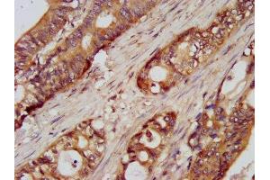 IHC image of ABIN7175108 diluted at 1:100 and staining in paraffin-embedded human colon cancer performed on a Leica BondTM system. (UMPS anticorps  (AA 314-444))