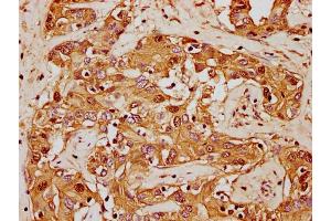 IHC image of nforHU diluted at 1:20 and staining in paraffin-embedded human liver cancer performed on a Leica BondTM system.