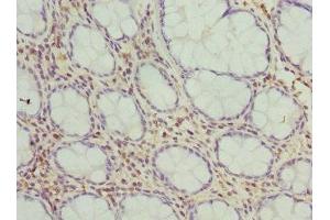 Immunohistochemistry of paraffin-embedded human colon cancer using ABIN7149954 at dilution of 1:100 (FMO1 anticorps  (AA 363-532))
