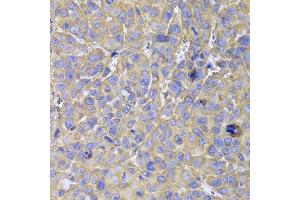 Immunohistochemistry of paraffin-embedded mouse cancer using HSPA14 antibody at dilution of 1:100 (x400 lens). (HSPA14 anticorps)