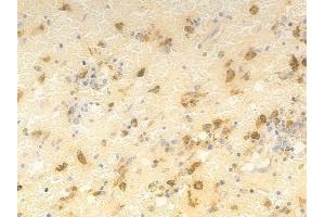 ABIN6261673 and ABIN6276895 at 1/100 staining human melanoma by IHC-P.