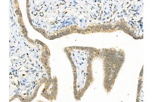 Phospho-YY1 (Ser365) Antibody at 1/100 staining Human ovarian cancer by IHC-P. (YY1 anticorps  (pSer365))