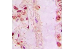 Immunohistochemical analysis of NRF2 staining in human lung cancer formalin fixed paraffin embedded tissue section.