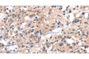 Immunohistochemistry of paraffin-embedded Human thyroid cancer tissue using CYP2D6 Polyclonal Antibody at dilution 1:40 (CYP2D6 anticorps)