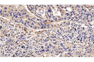 Detection of CNN1 in Human Lung cancer Tissue using Polyclonal Antibody to Calponin 1, Basic (CNN1) (CNN1 anticorps  (AA 1-268))