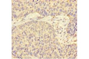 Immunohistochemistry of paraffin-embedded human ovarian cancer using ABIN7170819 at dilution of 1:100