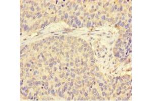 Immunohistochemistry of paraffin-embedded human ovarian cancer using ABIN7170819 at dilution of 1:100 (STIP1 anticorps  (AA 1-543))