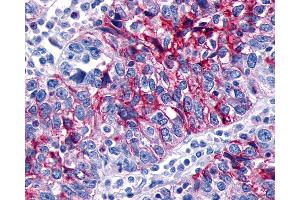 Anti-GPR133 antibody IHC of human Ovary, Carcinoma. (G Protein-Coupled Receptor 133 anticorps  (N-Term))