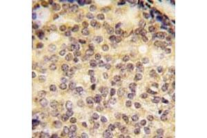 IHC analysis of FFPE human prostate carcinoma tissue stained with SOX9 antibody